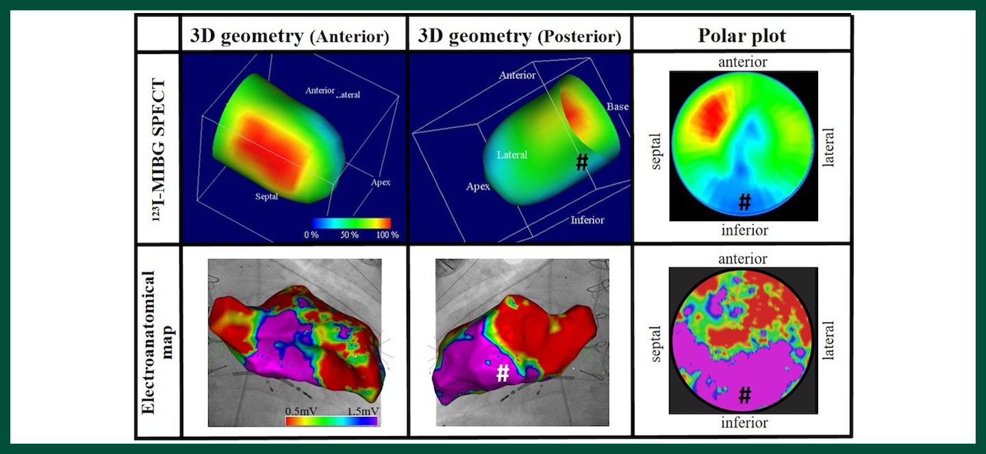 imaging of hearts with ischemic cardiomyopathy